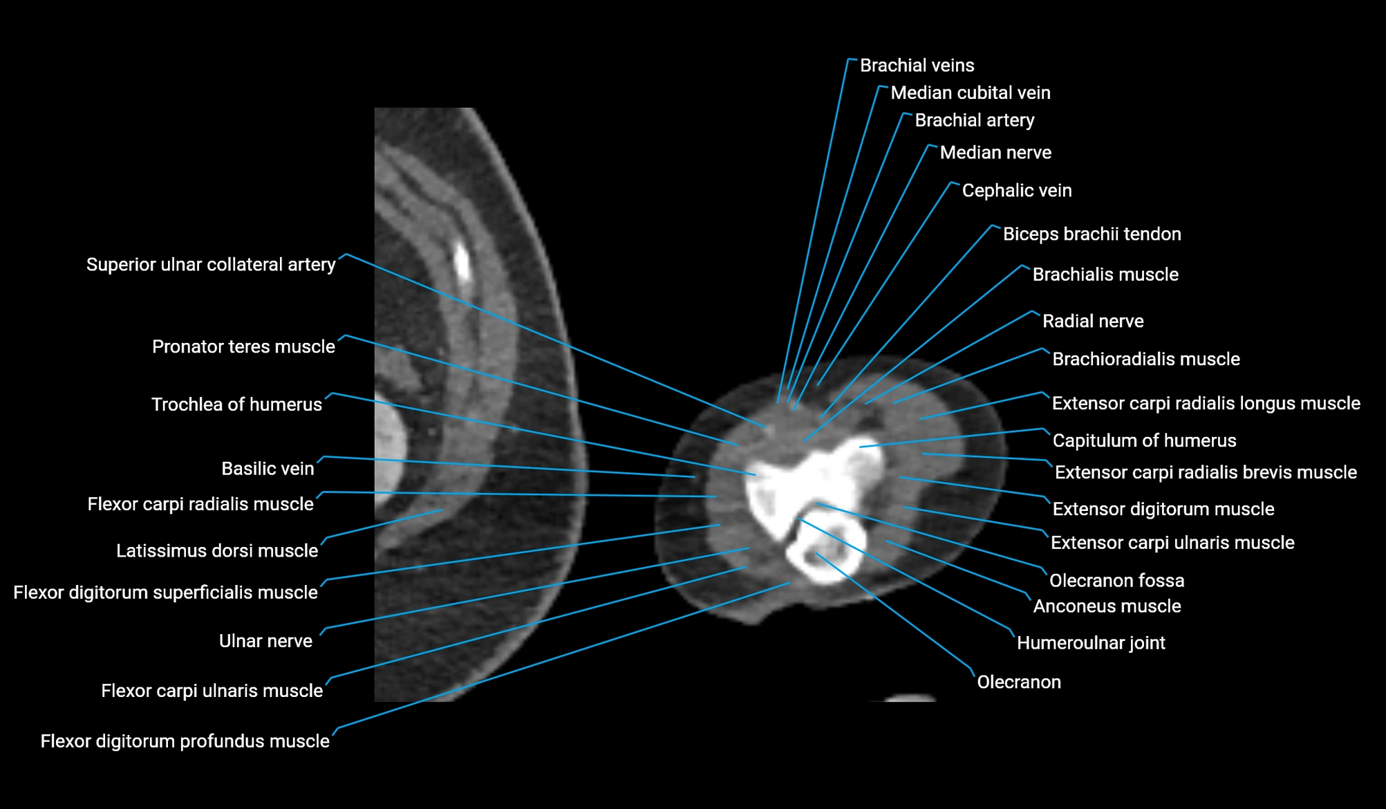 CT upper arm axial  cross sectional anatomy labelled radiology image -00394.webp